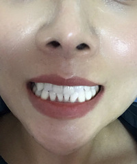 再也不想做牙齿冷光美白了