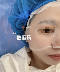 祛痘微针安排