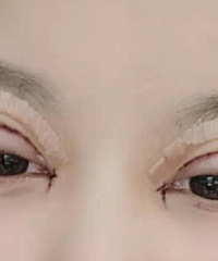 分享双眼皮一个月的恢复之路,艰难但不漫长