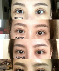 关于双眼皮手术,我来讲一讲我的经验(保姆级分享)