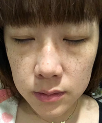 祛斑3次后,全脸的斑都变淡,老年斑已经没有了