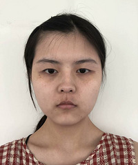 做了双眼皮像变了个人,也太自然好看了