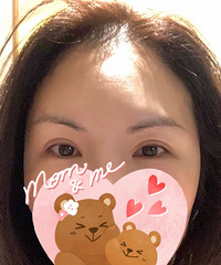 陪伴十年的双眼皮,想不到我还是去修复了