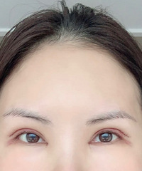 陪伴十年的双眼皮,我还是忍不住去做了修复手术