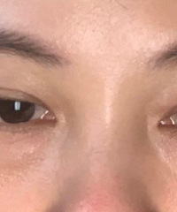 姐妹都在做医美,我也凑热闹去做掉了眼袋