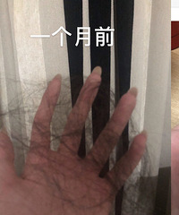 一个月拯救掉发,治疗脂溢性脱发方法分享