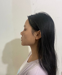 我的实录:做鼻综合是一种怎样的体验?