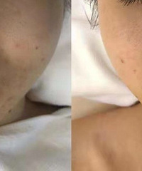 这个皮肤管理项目做完,肤色提亮痘印也淡了点