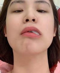 不寻常的分享——正畸经历,有顾虑的宝贝看过来