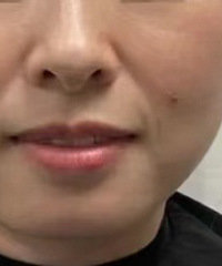 我朋友的法令纹突然减轻了,原来是做了这个
