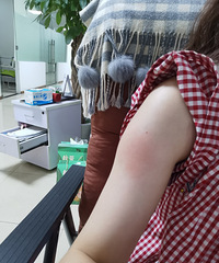 新冠疫苗(智飞)第二针注射一周后红肿、瘙痒加重,这正常吗?