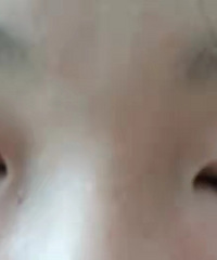 求助帖!!我妹妹这样的肿泡眼割什么样的双眼皮合适?