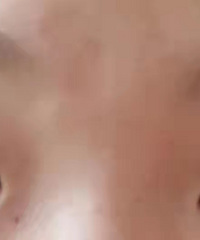 求助帖!!我妹妹这样的肿泡眼割什么样的双眼皮合适?