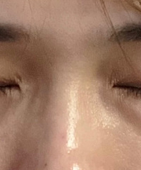 一次性做了眼袋和提眉,是梁静茹给我的勇气吗?