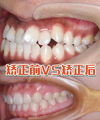 成都做牙齿矫正医院,成都贝臣牙科牙齿矫正案例。