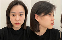 为了婚礼开始做医美,热玛吉做完脸直接变小一圈
