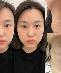 安排7种医美!这个做完,脸变小了一圈