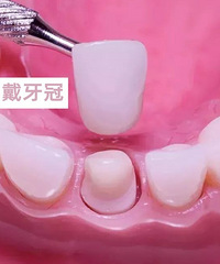 根管治疗后,需要戴牙冠吗(成都贝臣口腔医院科普)