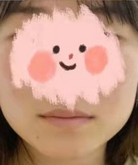 瘦脸针半个月后效果最佳,总算不是方脸女孩了