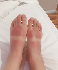最省钱的晒伤修复,晒伤红肿疼痛如何修复?