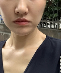 填了3支玻尿酸,脸上饱满了人也好看很多