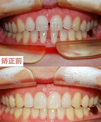 想在成都做牙齿矫正,(贝臣口腔)想知道正畸后能改变脸型吗?