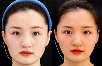 打造全新“半永久明星脸”,这里有个强效瘦脸法