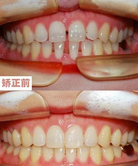 成都贝臣牙齿矫正,牙缝大是做矫正好?还是牙贴面好?