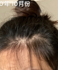 求求你们救救我脱发掉发秃发