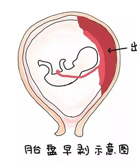 胎盘早剥到底有多可怕?分分钟,宝宝可能就没了……