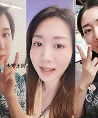 第二次矫正牙齿之后,终于变得整齐了