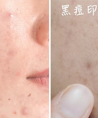你买的祛痘印产品,可能90%都没有用!看完这些你就知道了