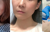 不得不说医美确实有用,填充过后真的年轻了5岁