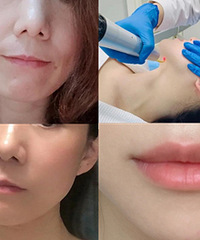 体验了医美才知道多香,我皱纹都没有了