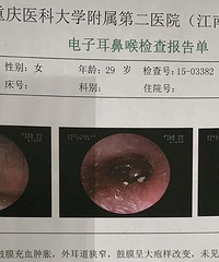 大疱性鼓膜炎会疼到si,大家注意