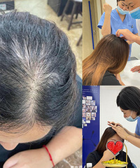 头秃后面诊3家机构,却都不建议我植发