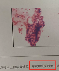 我33岁,家有俩娃,刚确诊甲状腺癌