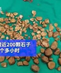 上海男子膀胱藏近200颗石子!
