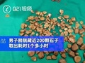 男子膀胱藏2百颗石子