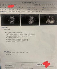 怀双胞胎28周居然还同房,结果两个孩子早产