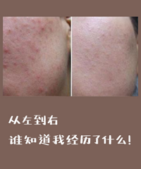 网上那些超热门的祛痘印神器真的有效吗?