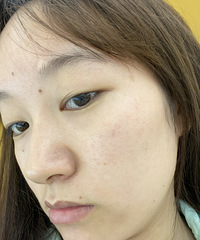 ��¼һ������˫��Ƥ�Ļָ����̣��б仯�����Ǿ��ã�