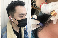 不吃药不做手术,轻松就能长出发际线