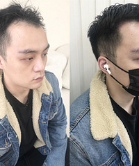 不吃药不做手术,轻松就能长出发际线!