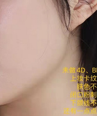 ��ҽ������񫣬�ڶ�������BBL��Fotona4D