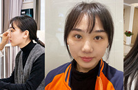 没想到1个小时,就让跟随我10年的眼袋消失了