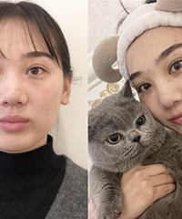 只花一小时,跟随我十年的眼袋就消失了