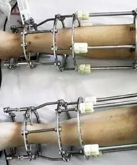 ��16��Ϲǣ�ֻΪ����7.2���׵�����ŵ����������֢Ϊ��