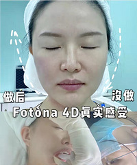 35��С���̵�һ�νӴ���˥��fotona 4D��