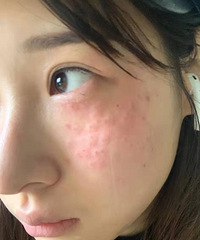 ����ҽԺƤ���������ȫ���̣��ײ�iPhoneǰ��